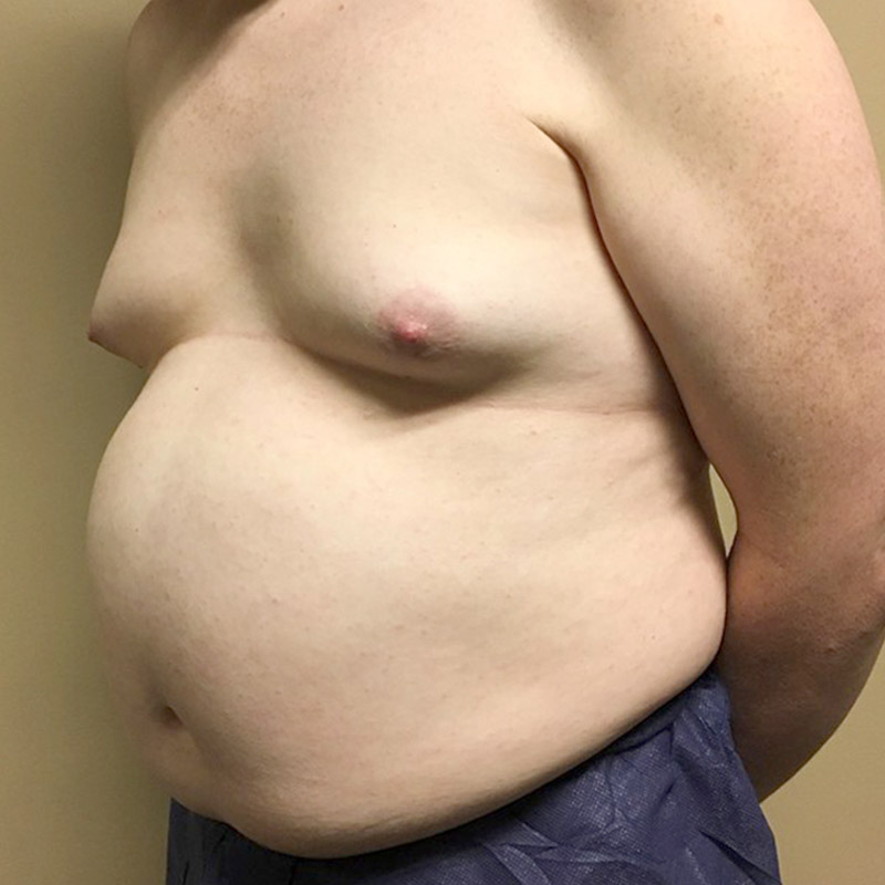 Mtf Breast Augmentation 07