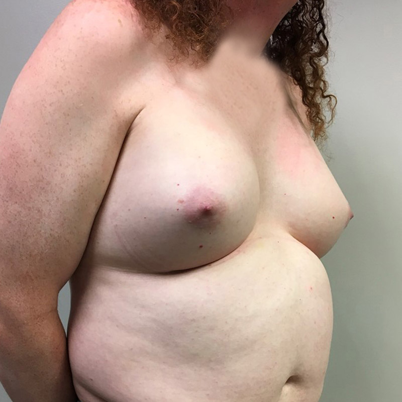 Mtf Breast Augmentation 09