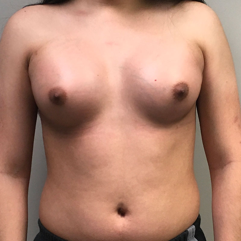 Mtf Breast Augmentation 15