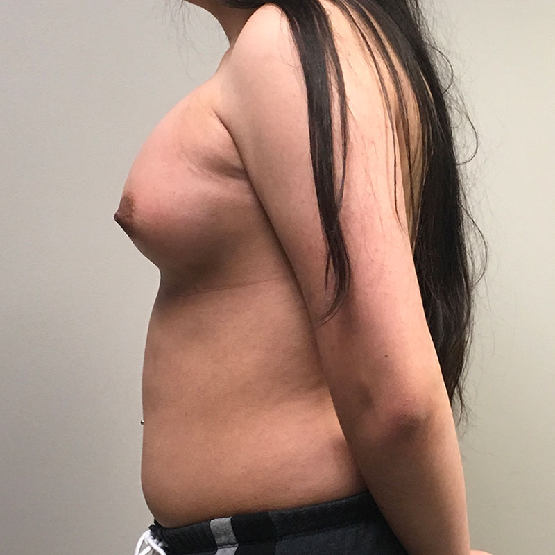 Mtf Breast Augmentation 05