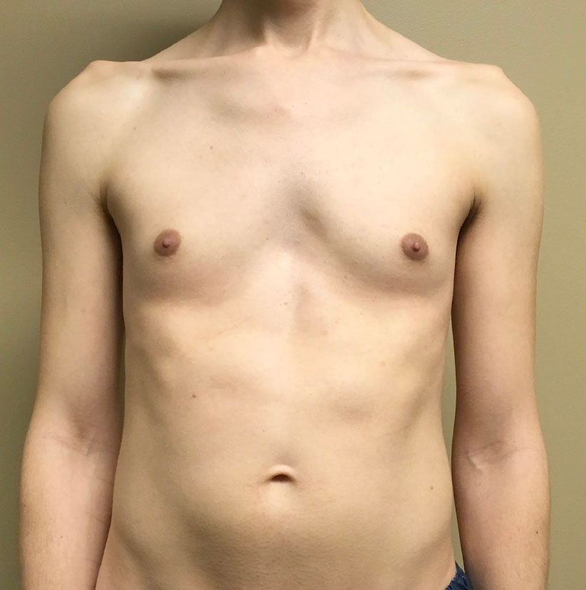 Mtf Breast Augmentation 01