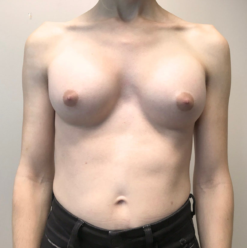 Mtf Breast Augmentation 16