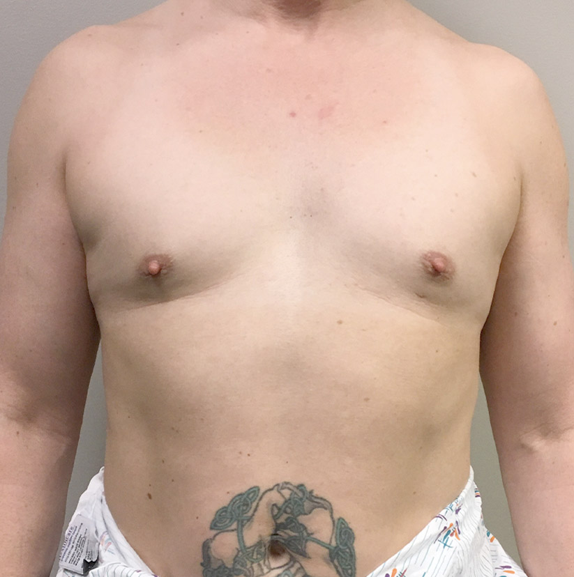 Mtf Breast Augmentation 01