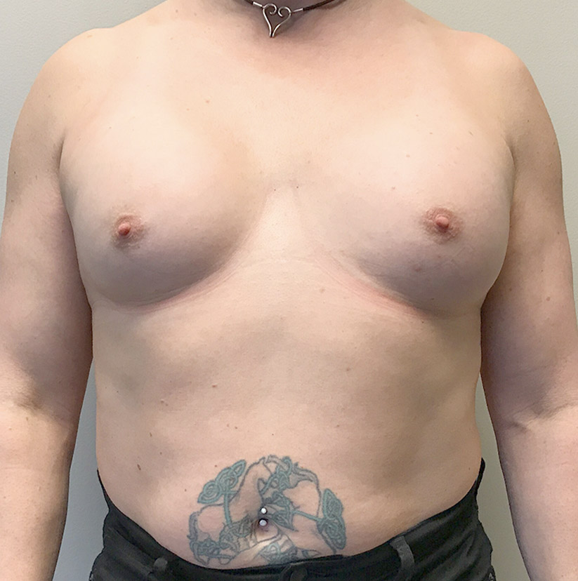 Mtf Breast Augmentation 17