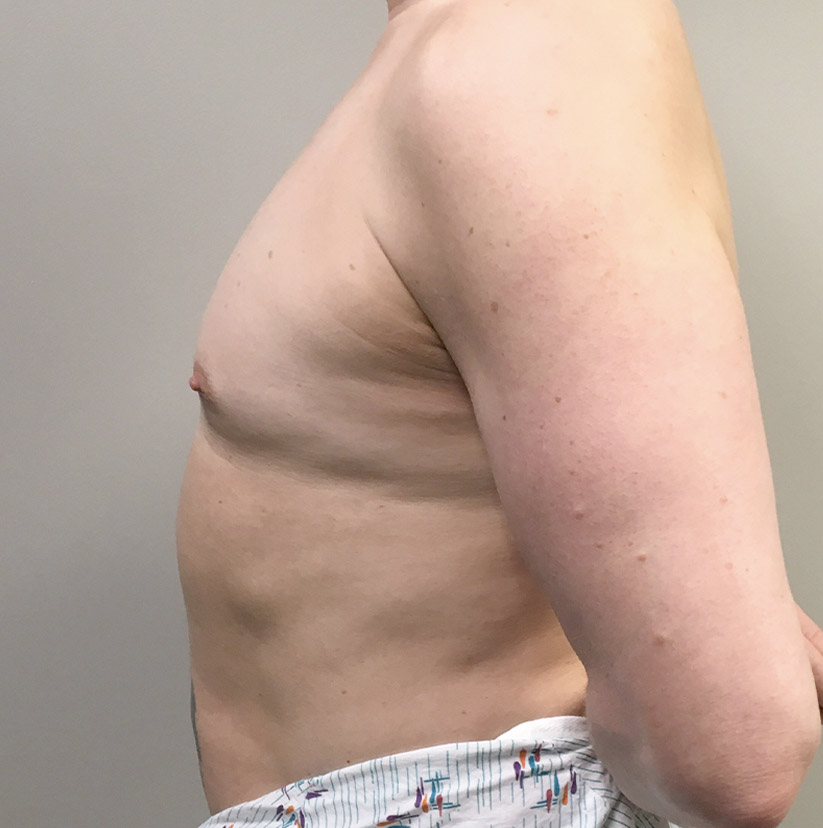 Mtf Breast Augmentation 03