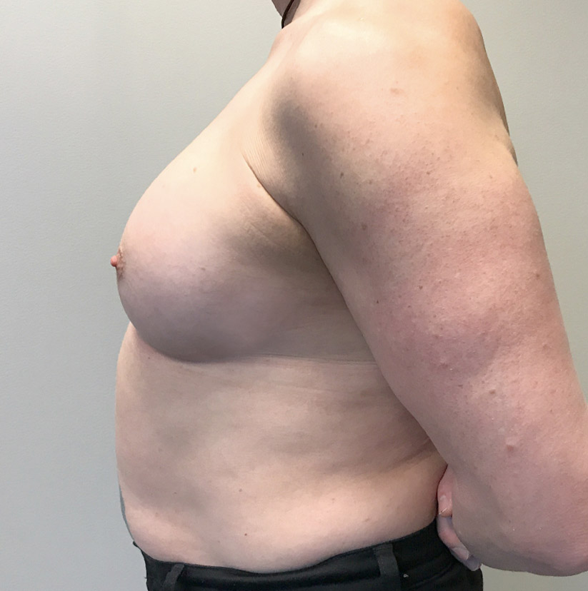 Mtf Breast Augmentation 03