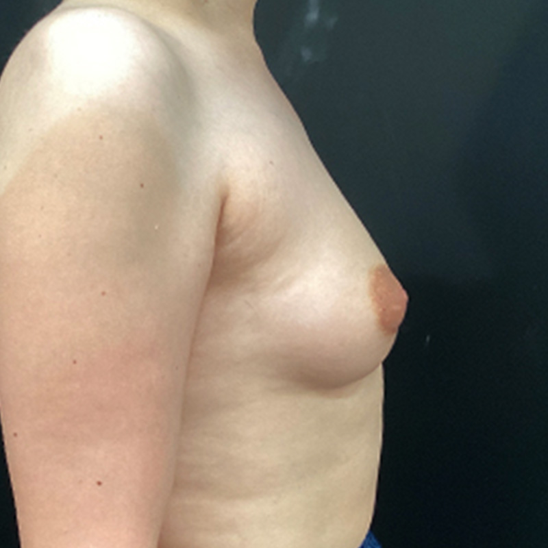 Mtf Breast Augmentation 05