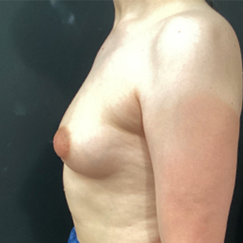 Mtf Breast Augmentation 09