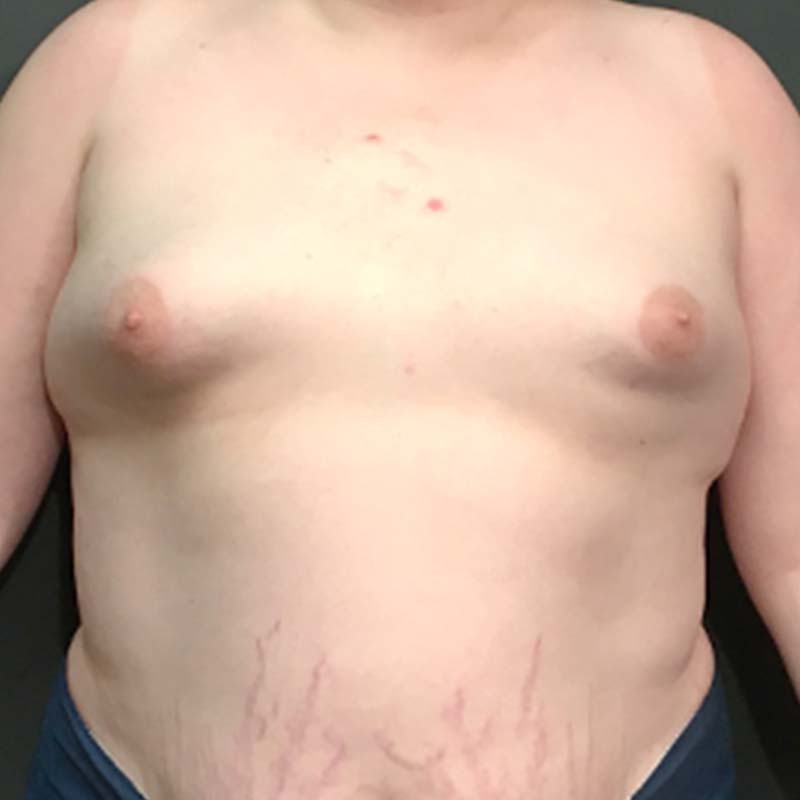 Mtf Breast Augmentation 01