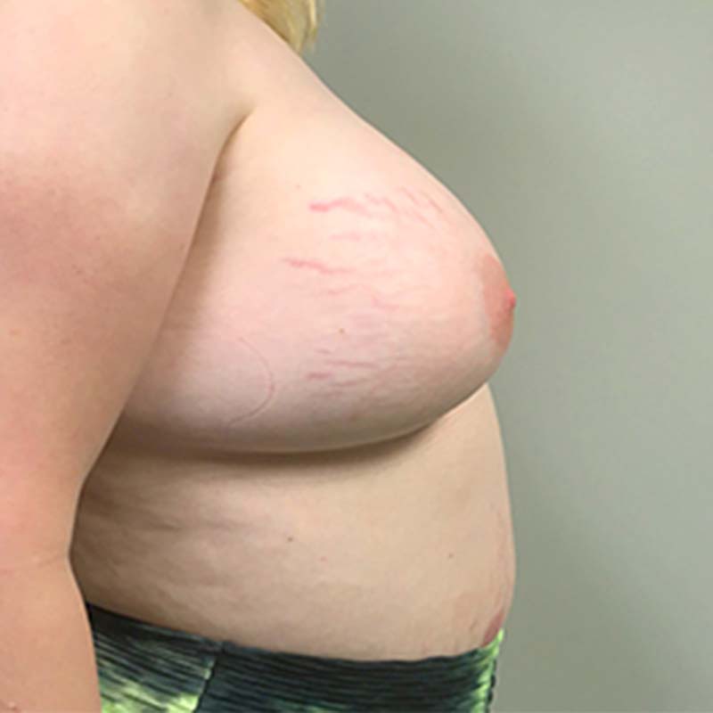 Mtf Breast Augmentation 09