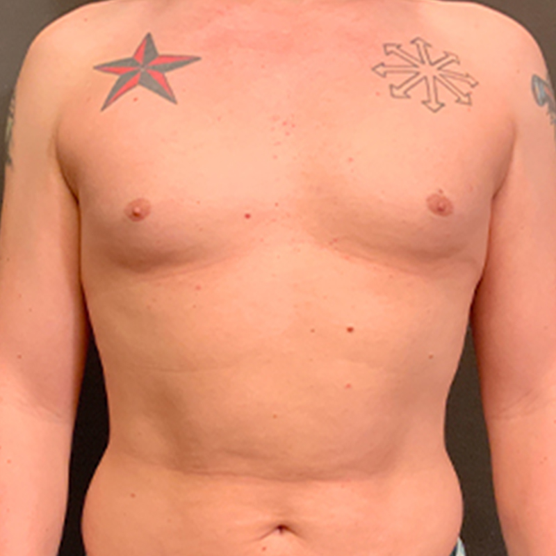 Mtf Breast Augmentation 01