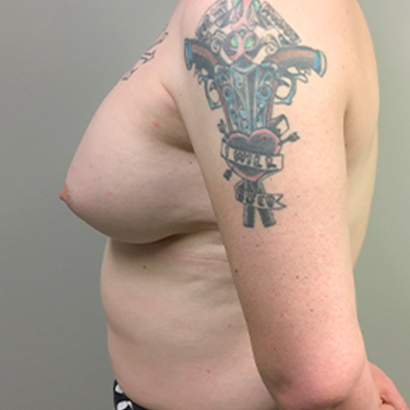 Mtf Breast Augmentation 05