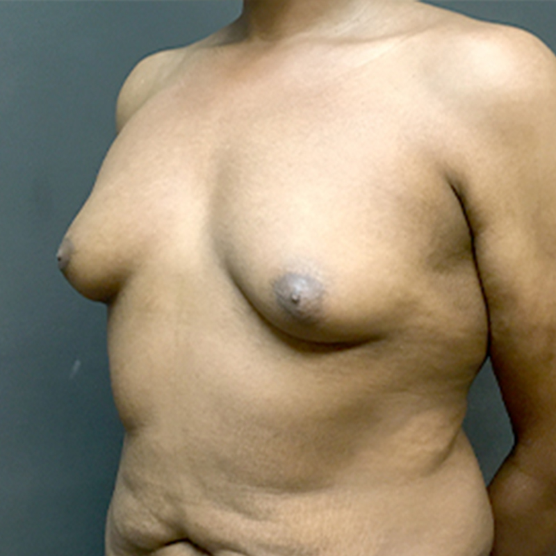 Mtf Breast Augmentation 03