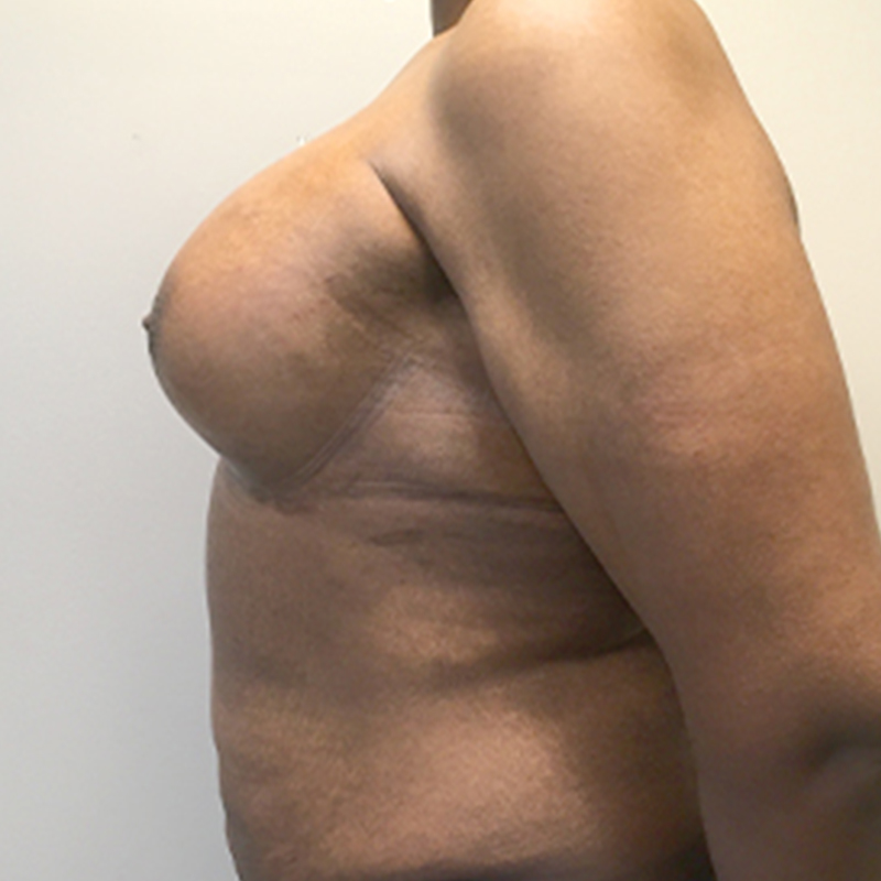 Mtf Breast Augmentation 05