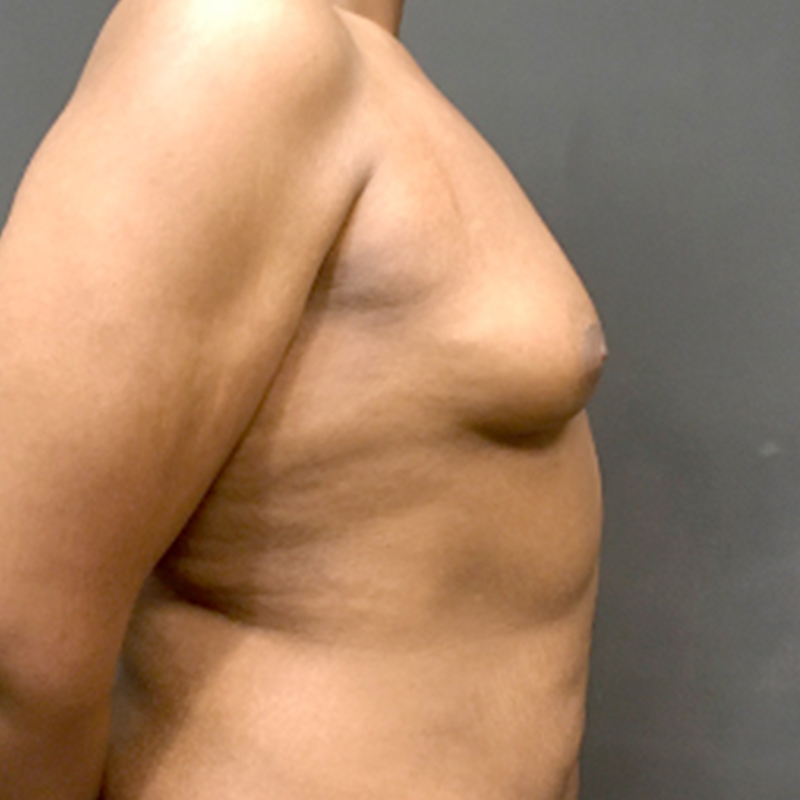 Mtf Breast Augmentation 09