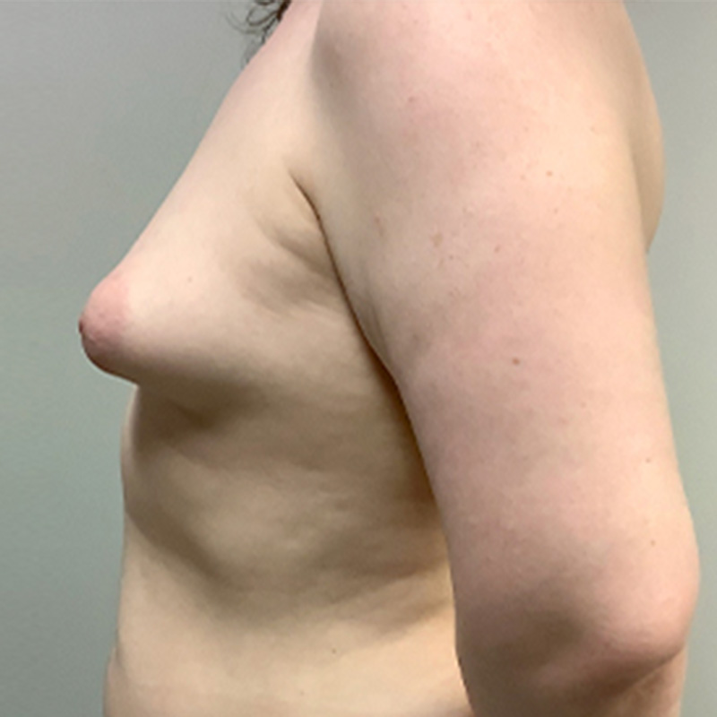 Mtf Breast Augmentation 09
