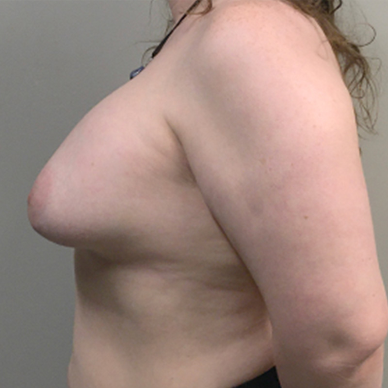 Mtf Breast Augmentation 09