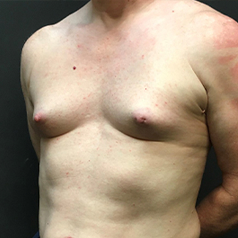 Mtf Breast Augmentation 03