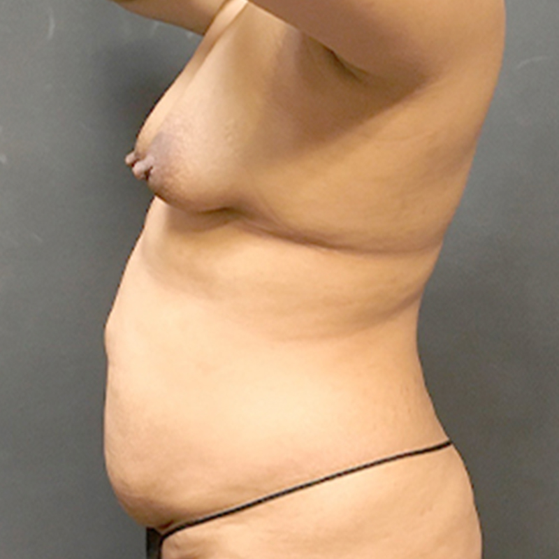 Mtf Breast Augmentation 05