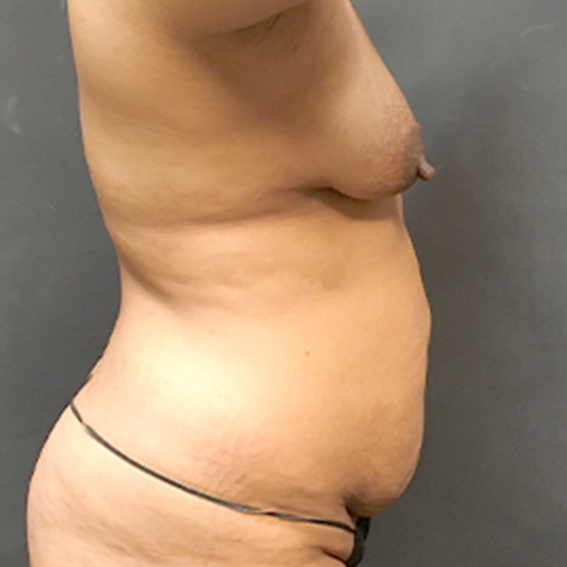 Mtf Breast Augmentation 09