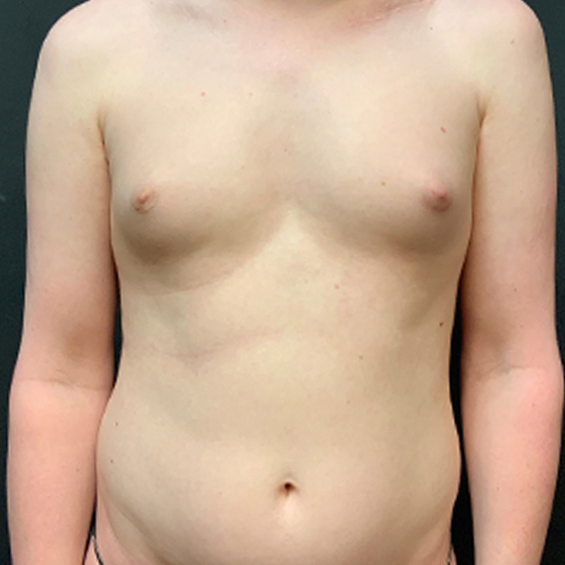 Mtf Breast Augmentation 01