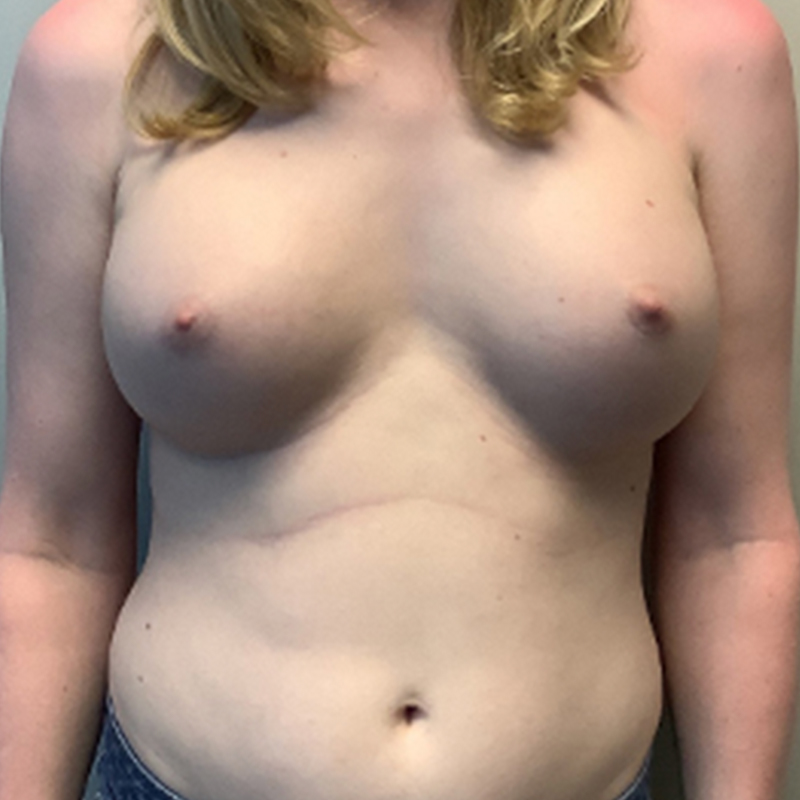 Mtf Breast Augmentation 26