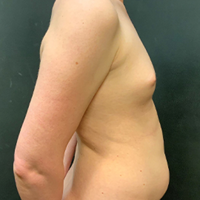 Mtf Breast Augmentation 05