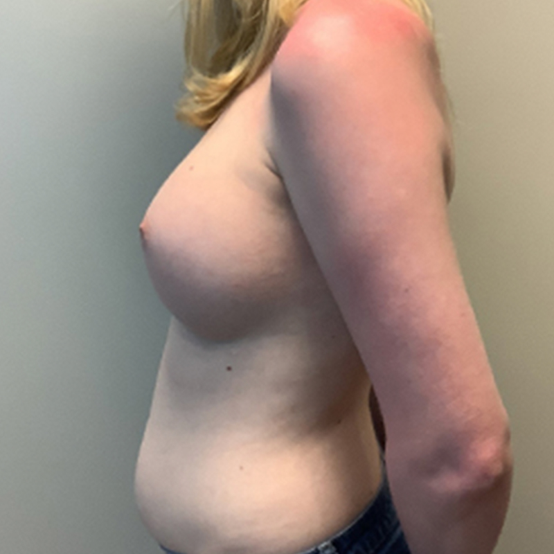 Mtf Breast Augmentation 09