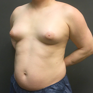 Mtf Breast Augmentation 03