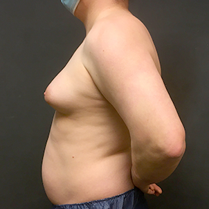 Mtf Breast Augmentation 05