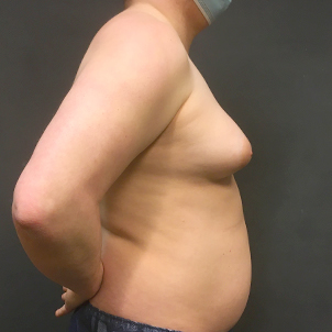 Mtf Breast Augmentation 07