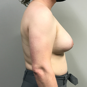 Mtf Breast Augmentation 07