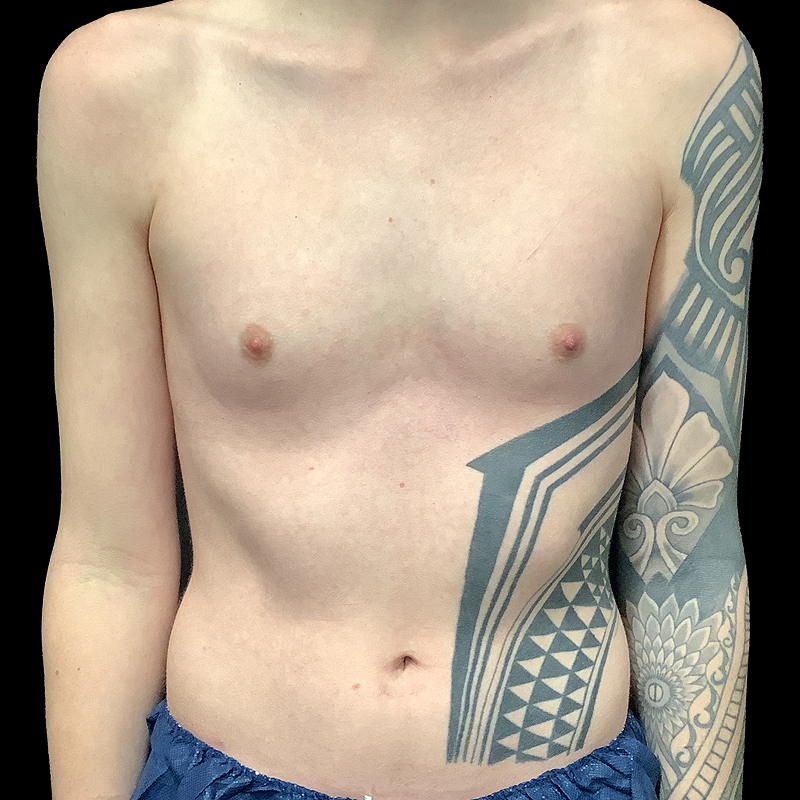 Mtf Breast Augmentation 01