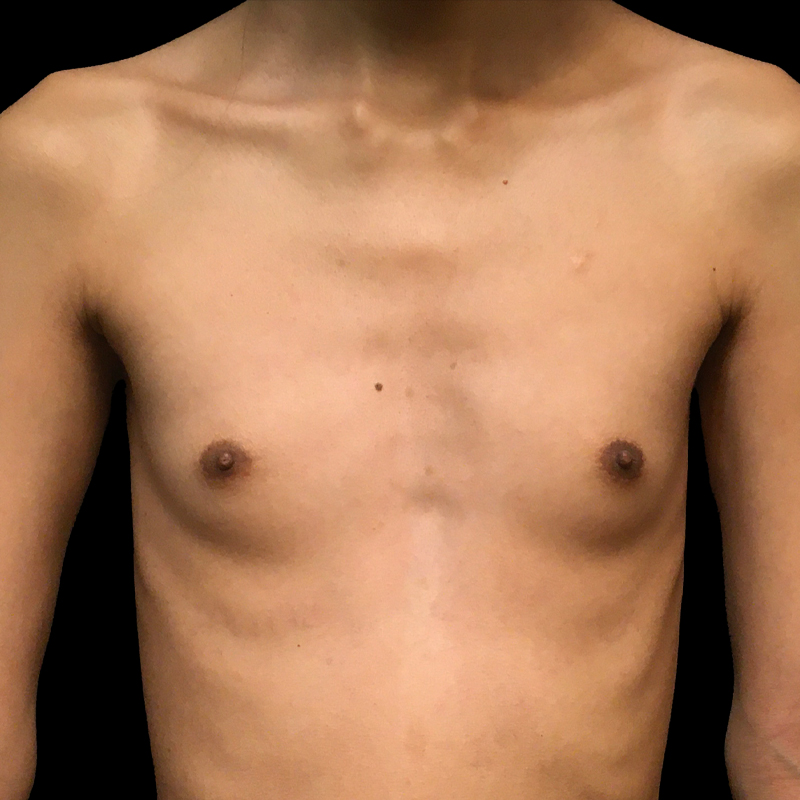 Mtf Breast Augmentation 01