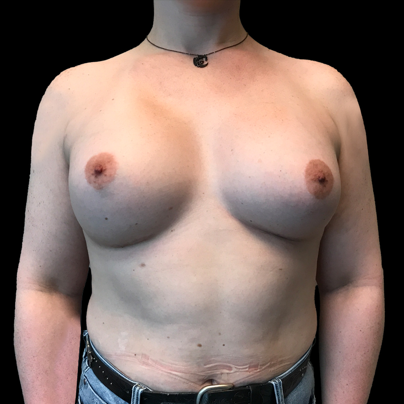Mtf Breast Augmentation 32