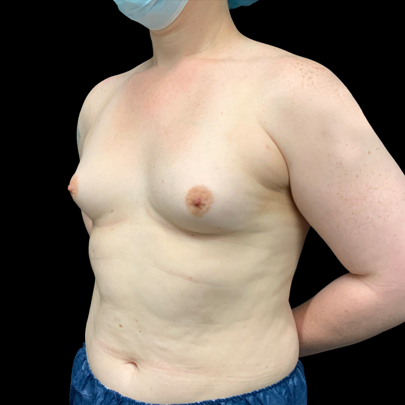 Mtf Breast Augmentation 03