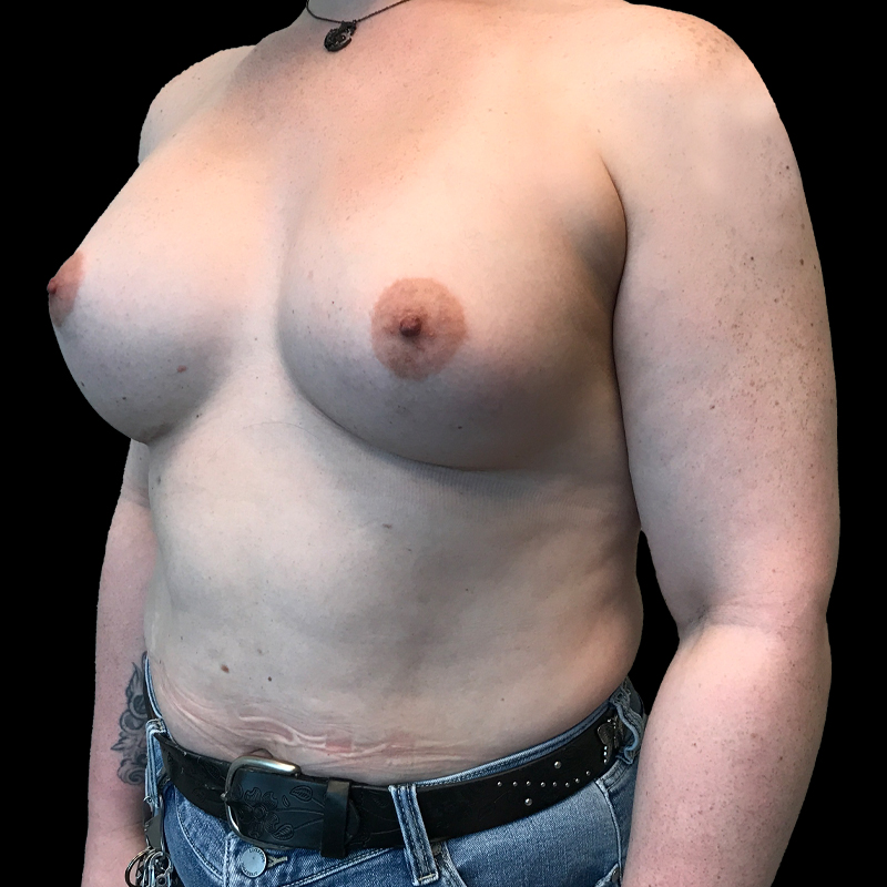 Mtf Breast Augmentation 03