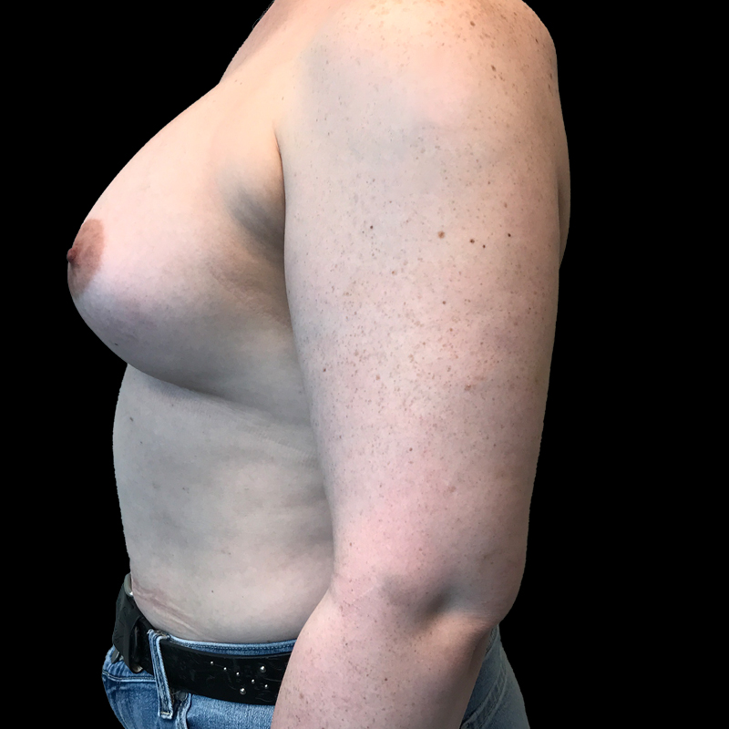 Mtf Breast Augmentation 05
