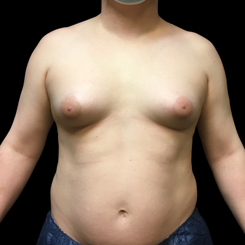 Mtf Breast Augmentation 01
