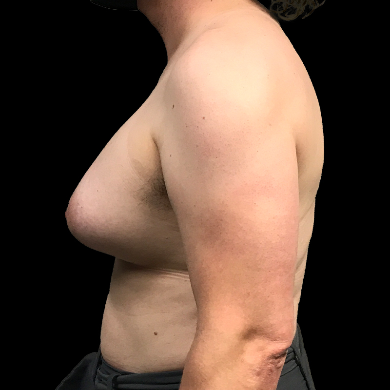 Mtf Breast Augmentation 05