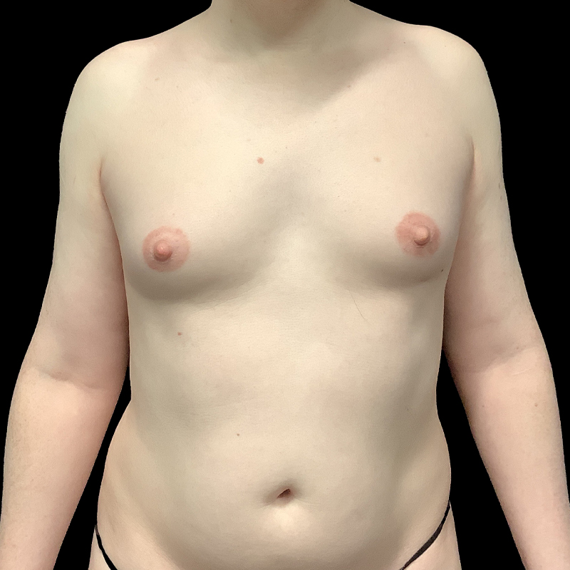 Mtf Breast Augmentation 01