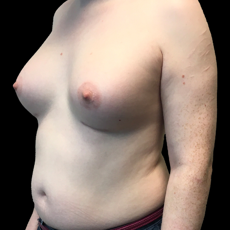 Mtf Breast Augmentation 03