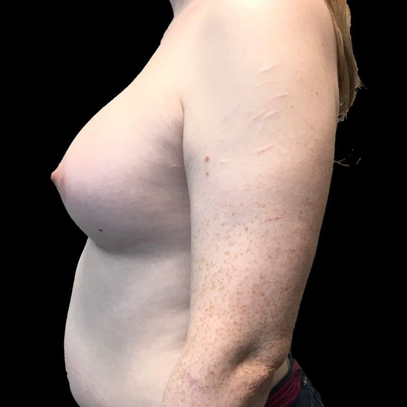 Mtf Breast Augmentation 05