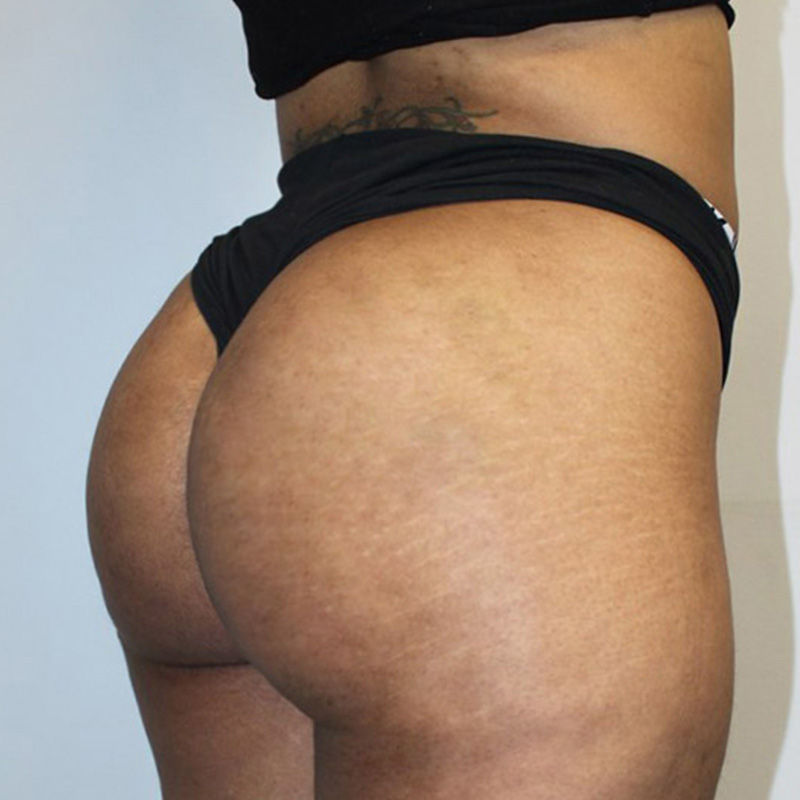 Non Surgical Brazilian Butt Lift 03