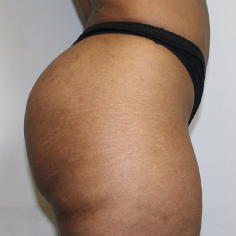 Non Surgical Brazilian Butt Lift 05
