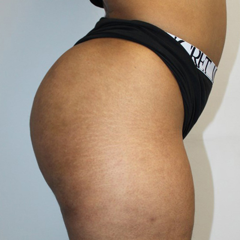 Non Surgical Brazilian Butt Lift 05