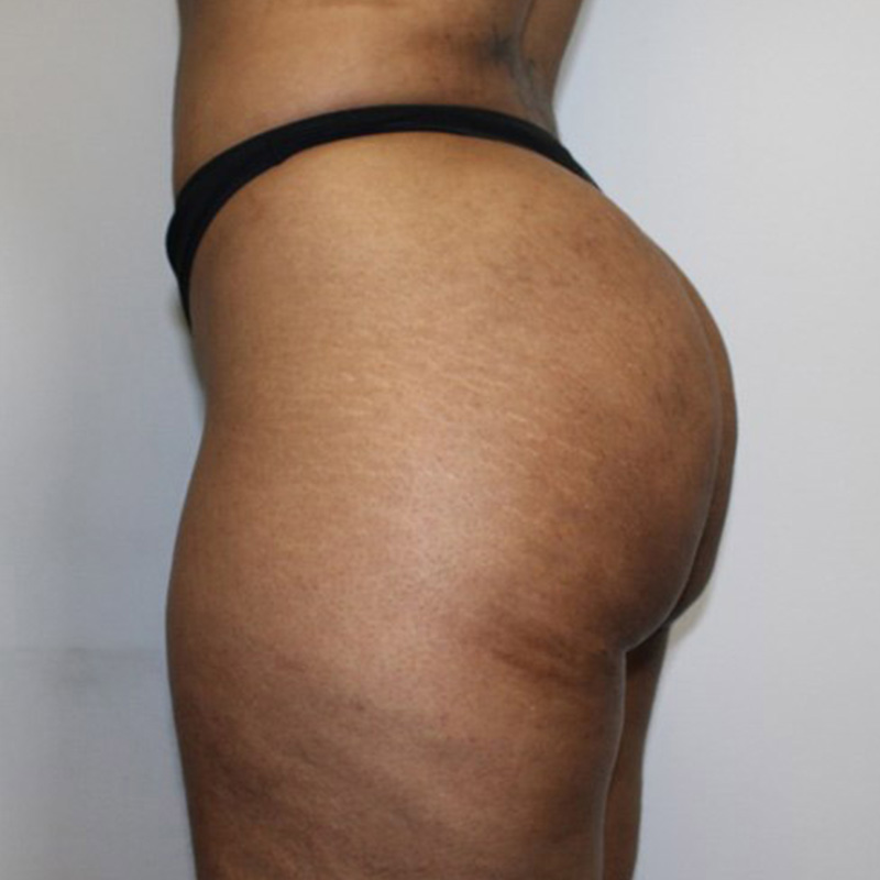 Non Surgical Brazilian Butt Lift 09