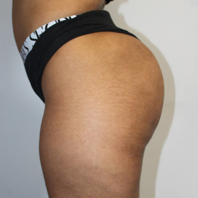 Non Surgical Brazilian Butt Lift 09