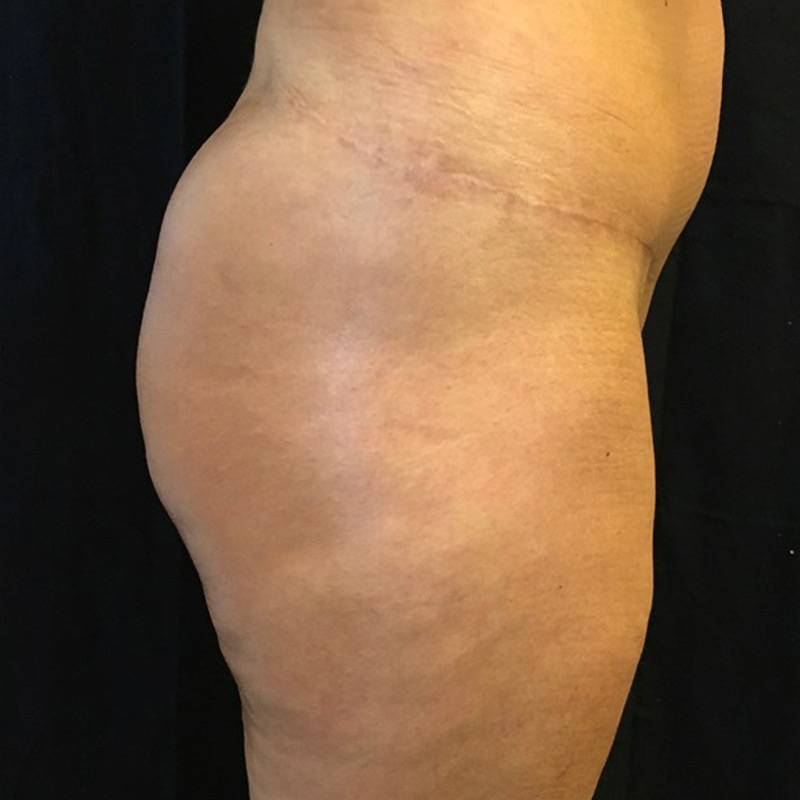 Non Surgical Brazilian Butt Lift 03