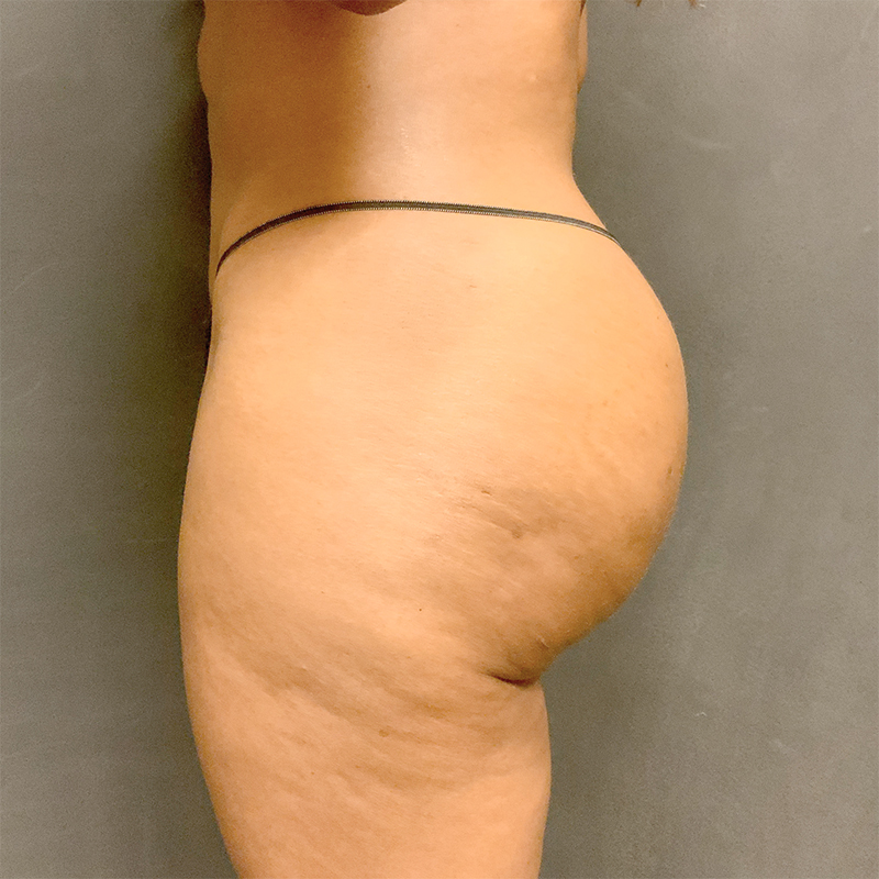 Non Surgical Brazilian Butt Lift 03